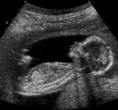 15 week